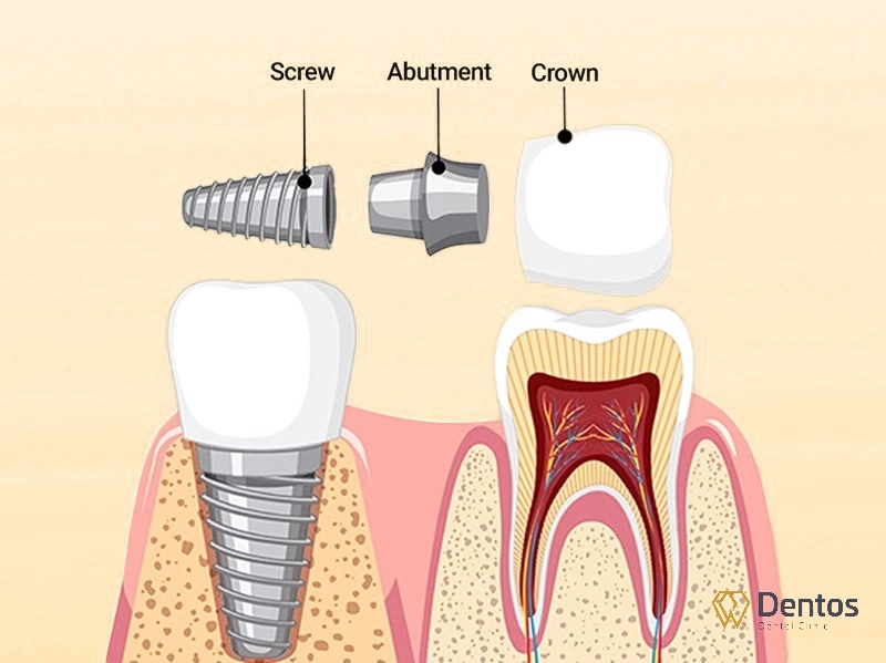 Trồng răng implant là giải pháp cho người bị mất răng tốt nhất